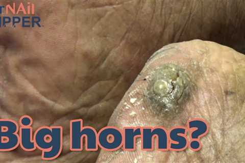 What is a Cutaneous Horn?  Callus Tuesday (2020)
